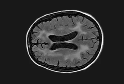 Frontal Lobe Dementia Wiki