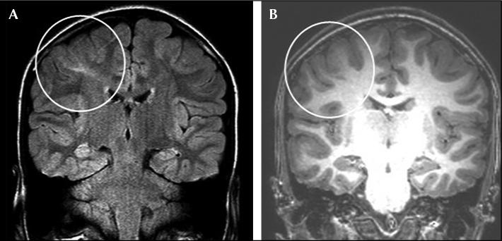 Frontal Lobe Epilepsy