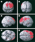 Frontal Lobe Epilepsy