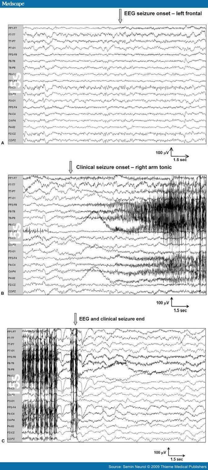 Frontal Lobe Epilepsy