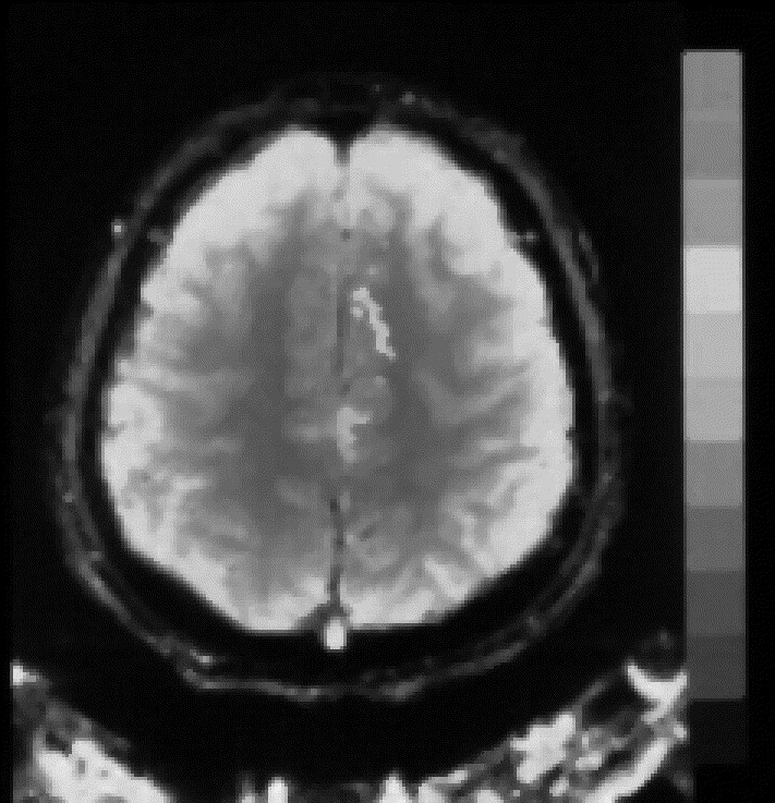 Frontal Lobe Epilepsy