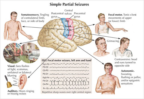 Frontal Lobe Epilepsy