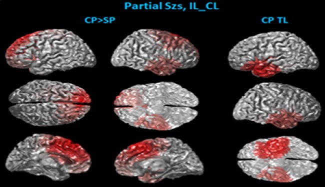 Frontal Lobe Epilepsy