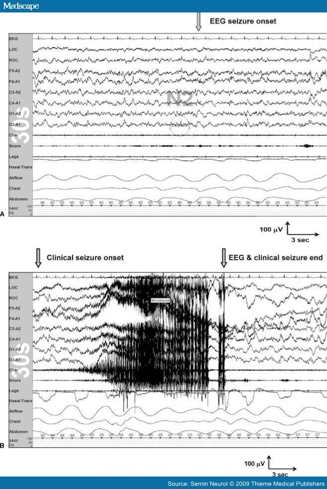 Frontal Lobe Epilepsy Sleep