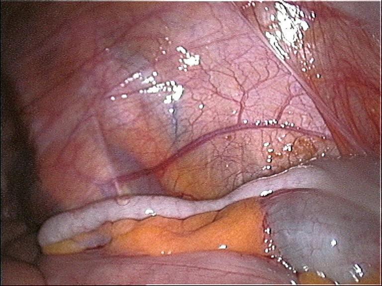 Human Appendix Location