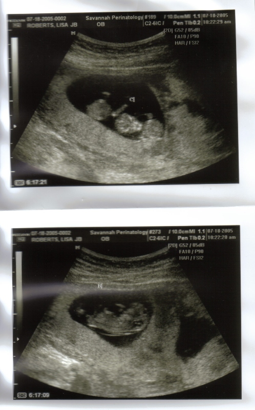 Identical Twins Pregnancy