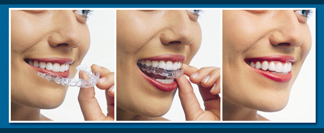 Invisalign Braces Cost