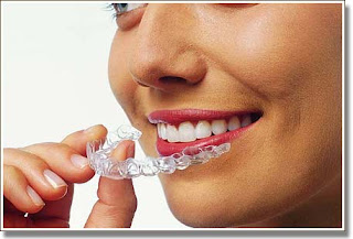 Invisalign Braces Prices