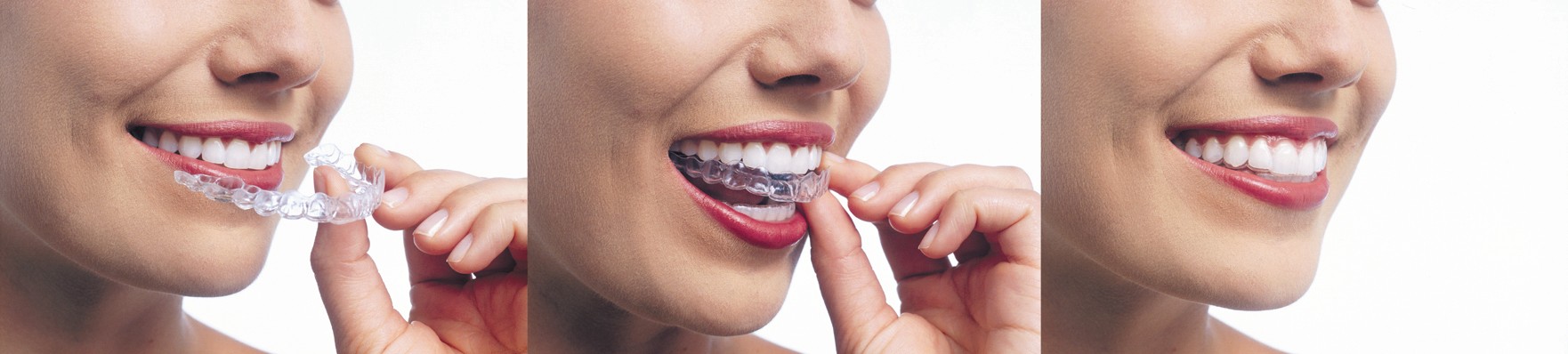 Invisalign Braces Prices