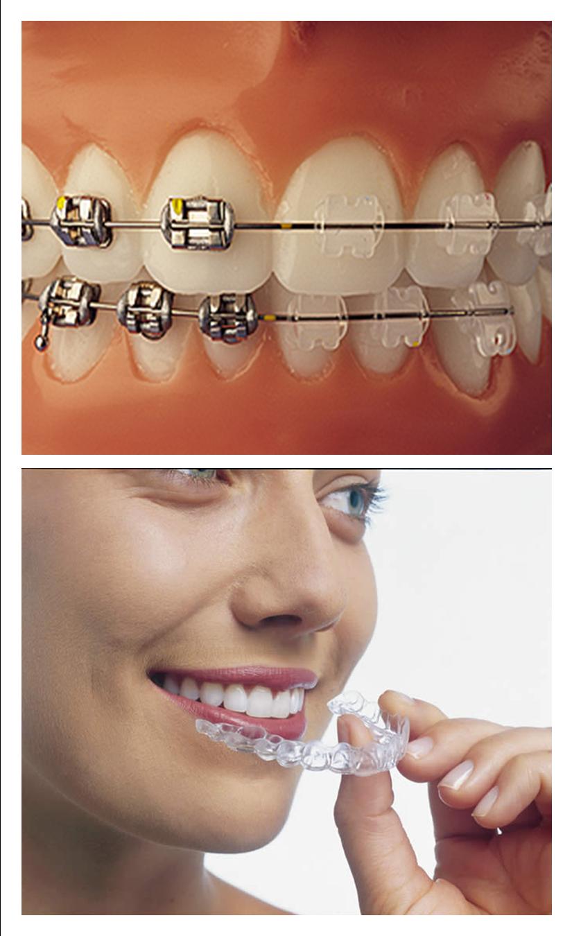 Invisible Braces Cost