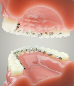 Invisible Braces For Teeth