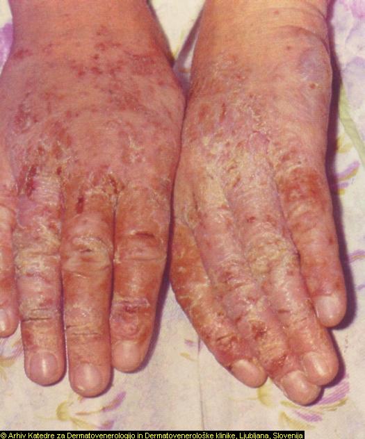 Irritant Contact Dermatitis Pictures