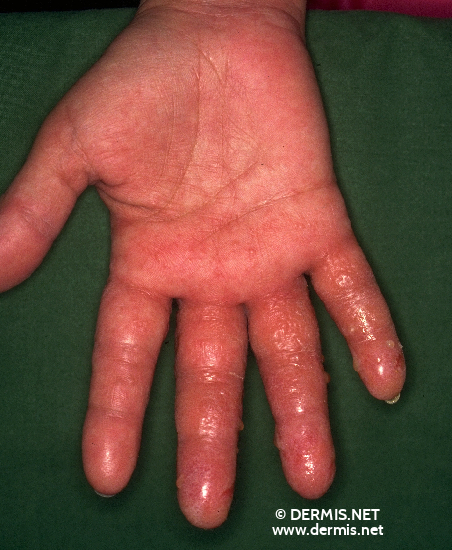 Irritant Contact Dermatitis Pictures