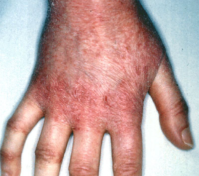 Irritant Contact Dermatitis Pictures