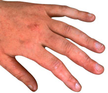 Irritant Contact Dermatitis Pictures