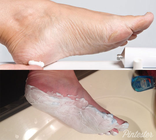 Listerine Foot Soak Pinterest