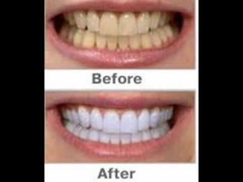 Listerine Whitening Strips Before And After