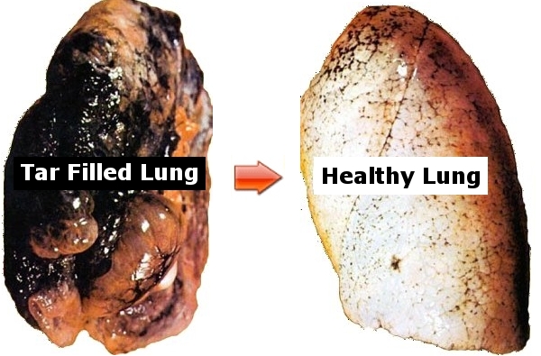 Lungs After Smoking