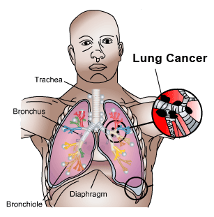 Lungs Cancer