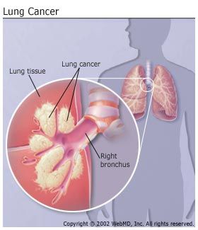 Lungs Cancer Symptoms Women