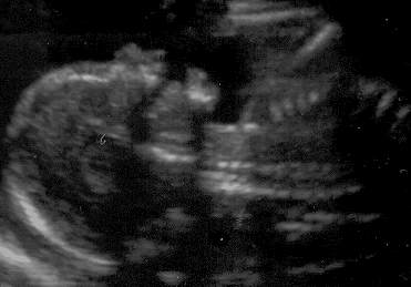 Miscarriage At 12 Weeks After Seeing Heartbeat