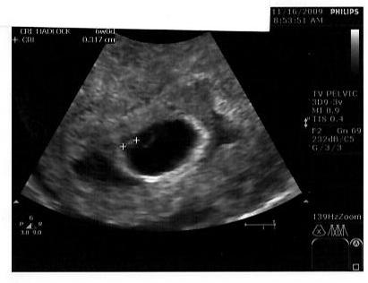 Miscarriage At 6 Weeks Images