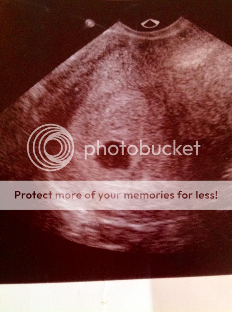 Miscarriage At 6 Weeks Images