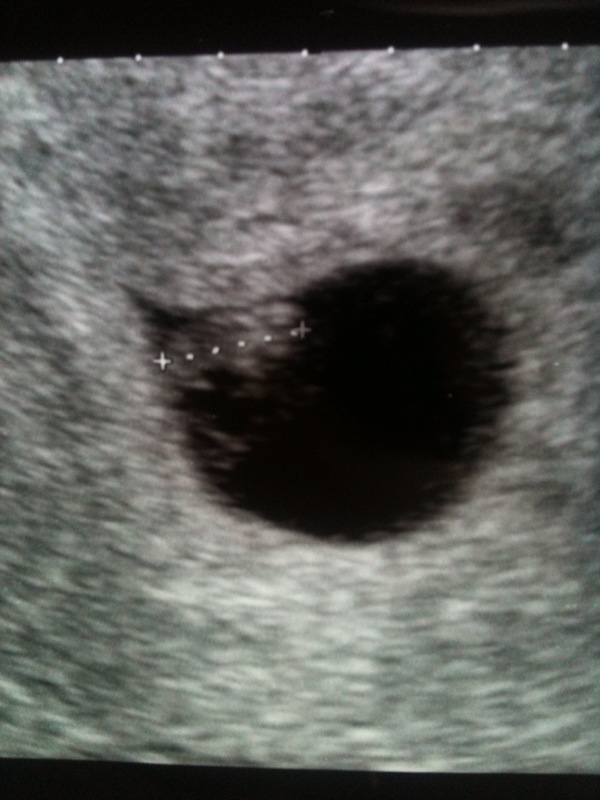 Miscarriage At 6 Weeks Pregnant