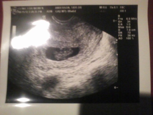 Miscarriage At 7 Weeks