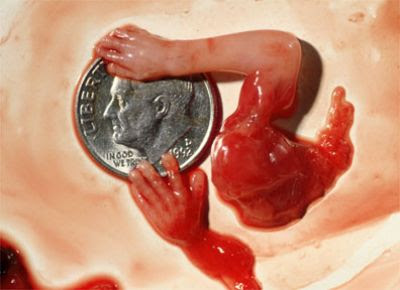 Miscarriage At 7 Weeks What Does It Look Like