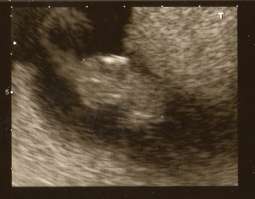 Miscarriage At 8 Weeks After Seeing Heartbeat