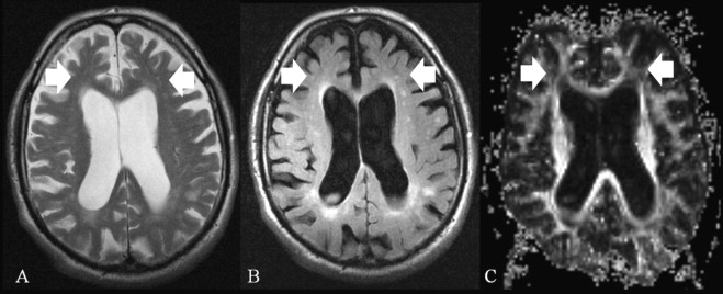 Mri Frontal Lobe Damage