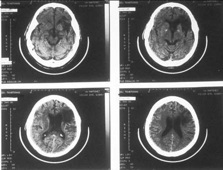 Mri Frontal Lobe Damage