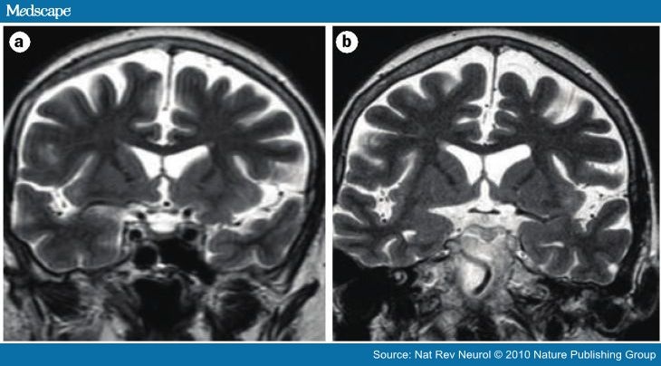 Mri Frontal Lobe Damage