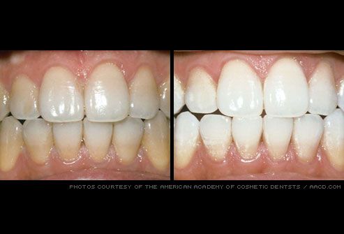 Pictures Of Healthy Gums And Teeth