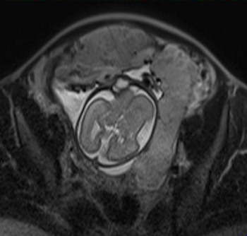 Placenta Accreta Mri Images