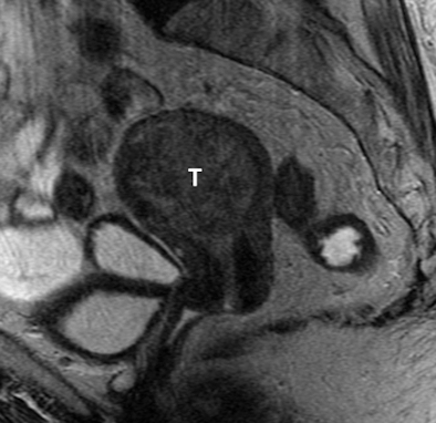 Placenta Accreta Mri Images