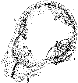 Placenta Accreta Mri Images