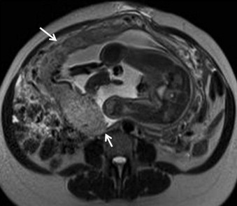 Placenta Accreta Mri Images