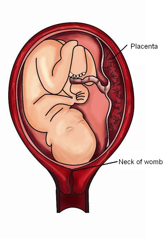 Placenta Accreta Mri Images