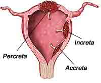 Placenta Accreta Mri Images