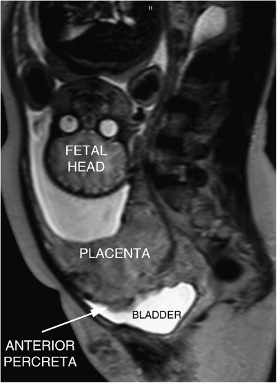 Placenta Accreta Mri Images