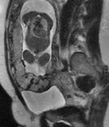 Placenta Accreta Mri Protocol