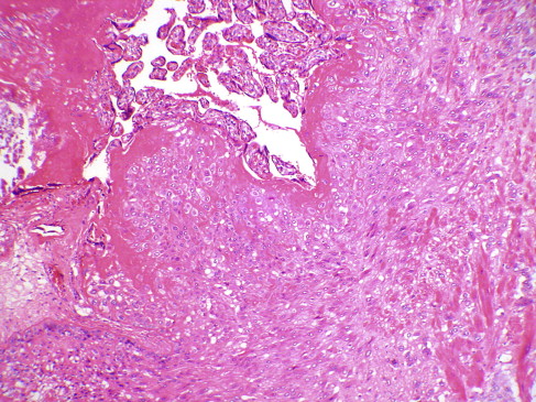 Placenta Accreta Mri Protocol