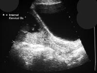 Placenta Accreta Mri Protocol