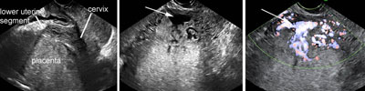 Placenta Accreta Ultrasound Findings