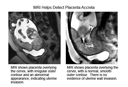 Placenta Accreta Ultrasound Findings