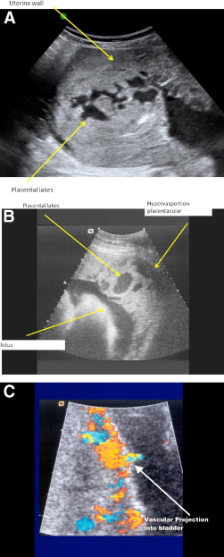 Placenta Accreta Ultrasound Findings