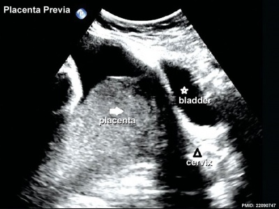 Placenta Accreta Ultrasound Findings