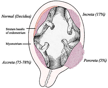 Placenta Accreta Ultrasound Findings